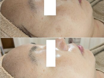 アン(anne)/ハーバルピール☆ レベル4×4回