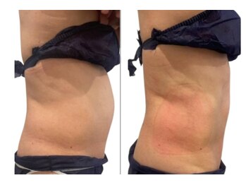 サロンドモフィ(salon de moffy)/痩身【脂肪冷却】おなか施術例２