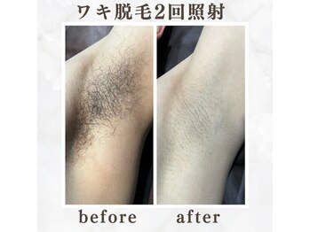 ボゴス 天白店(BOGOSS)/【脇脱毛】施術写真