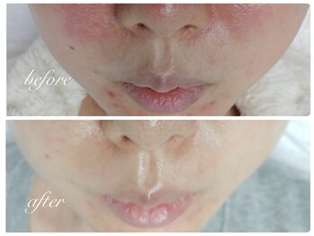 アリスビューティー(AliceBeauty)/ララピールで毛穴引き締め×艶肌