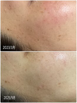 ブライトリー(Brightly)/毎日コツコツが美肌への近道です