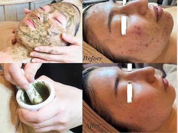 オプテリオンの写真/結果重視!ニキビ、シミ、シワ肌悩みを根本ケア。自らの肌力を引き上げ、本気の肌質改善で理想の素肌へ!