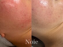 ノイエ(NOIE)/ハーブピーリング肌質改善　Noie