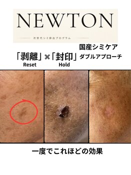 レガート(Legato)の写真/話題の塗って剥がれるシミケア！！NEWTON導入
広島初導入！！