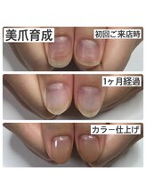 マニュコクーン(ManuCocoon)/爪育成　深爪　巻き爪　大阪市