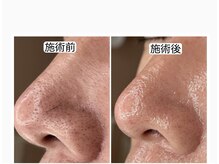 アロマ(AROMA)/黒ずみ毛穴(2)