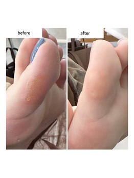 ネイルアトリエ ボン(nail atelier bon)/足裏角質ケア