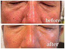 ルー ハナレ 神戸岡本 摂津本山店(Luu HANARE)/小顔シミ・毛穴・たるみ改善