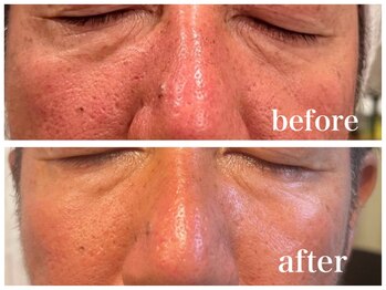 ルー ハナレ 神戸岡本 摂津本山店(Luu HANARE)/小顔シミ・毛穴・たるみ改善