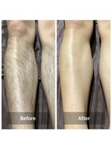 アマラ 日出店(AMARA)/【メンズ】脚のビフォーアフター