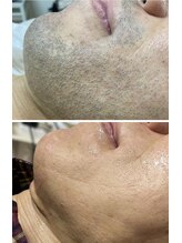 リバース 大曽根(Re.BIRTH)/BeforeAfter