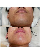 みんなのLED脱毛/男性・ひげ脱毛施術