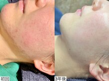 エモーショナル 姫路(Emotional)/３年ハーブピーリングをした結果