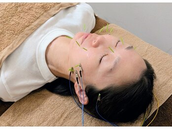 ホシ治療院/プレミアム美容鍼【小顔】