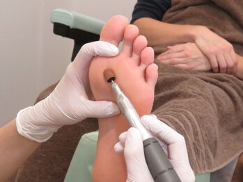 足のトラブルセンター 狸小路店/タコや魚の目も除去