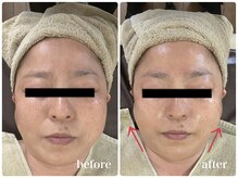 ジャスミン(Jasmin)/ダブルピール×イオン導入