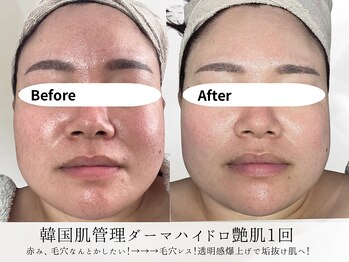 ミヨンラボ(miyon LABO)/韓国肌管理ダーマハイドロ1回