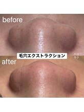 ハリサク/初回施術