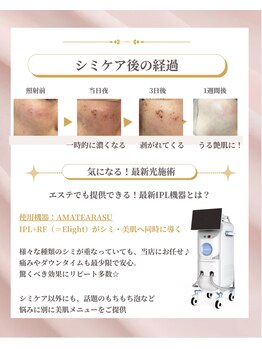 ドットフェイス(.Face)/山形初導入amaterasu