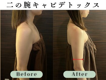 スイスパ 恵比寿(翠SUI SPA)/【二の腕引き締め】Before/After