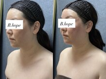 ビーホープ(B.hope)/40代モニター様1回目