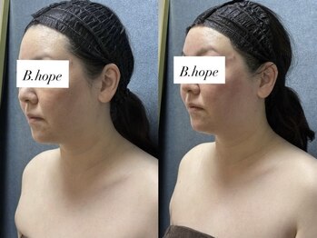 ビーホープ(B.hope)/40代モニター様1回目