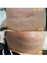 RiとBiのたまご/（脱毛）あご脱毛