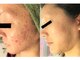全身脱毛専門店 tenの写真/[都度払いOK!]美容業界注目のプラズマ美容"リブセラ"は肌の深部へ効率良くアプローチし即効美肌を必ず実感!