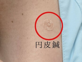 ホグステ/ペタッと貼って痛みもありません