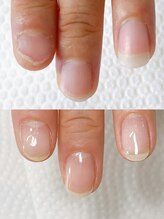 ハッチネイル(HACCI nail)/自爪育成　Before after 