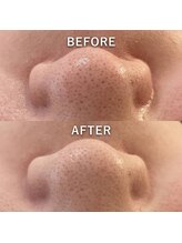 マーブルスタイル 横浜西口店(MARBLE STYLE)/【BeforeAfter】毛穴ケアAHA