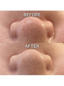 マーブルスタイル 横浜西口店(MARBLE STYLE)/【BeforeAfter】毛穴ケアAHA
