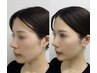  最先端美容【頭皮棘リフト】頭皮・顔のたるみ悩みに！¥22,000→19800