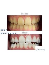 NAホワイトニング 自由が丘店/【before/after】