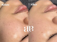 エーアイエー 四条烏丸店(A.i.a)/最強美肌ケア♪