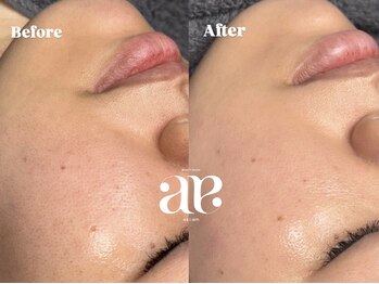 エーアイエー 四条烏丸店(A.i.a)/最強美肌ケア♪