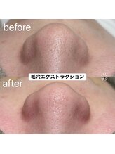 ハリサク/初回施術