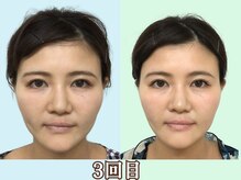 ナチュラルパーフェクトフェイス 新宿/３回目／新宿駅近小顔矯正専門店