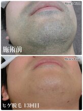 メンズ脱毛サロン ライオン 新宿(LION)&nbsp;店長 認定脱毛士