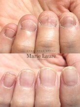 マリーロール 梅田店(Marie Laure)/自爪育成/深爪矯正/ネイルケア