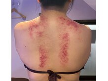 灯香庵 玉響(たまゆら)/【カッサ】首肩～背中