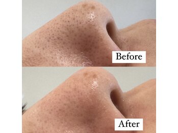 クレン(CLEN)/毛穴洗浄/ブライダル/美白