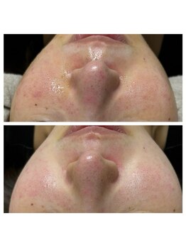 プレジール(PLAISIR)/ハーブピーリングBefore・After