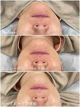 ミレーヴ(MiReve)/シミ・毛穴、小顔