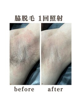 ボゴス 天白店(BOGOSS)/【脇脱毛】施術写真