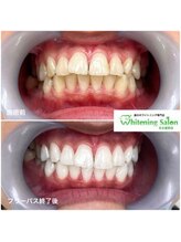 ホワイトニングサロン 名古屋駅店/【ホワイトニング施術例】