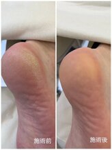 レフス 北参道店(REFUSS)/本格角質ケア