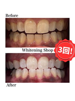 ホワイトニングショップ 新宿店/【ホワイトニング】BeforeAfter