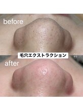 ハリサク/初回施術