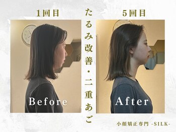 シルク(SILK)/二重顎・たるみ・猫背